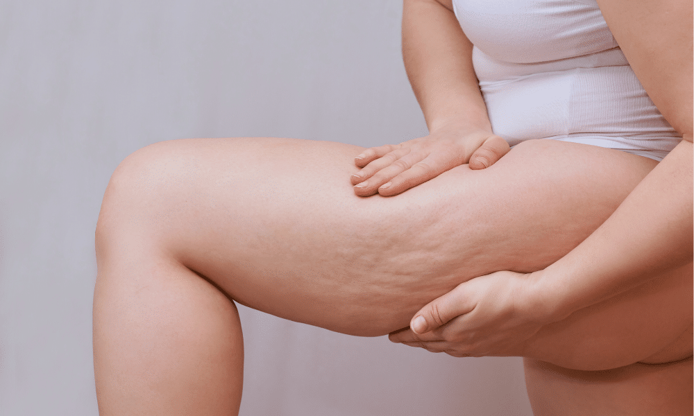 Você sabe o que é Lipedema?