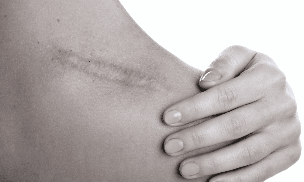 Correção de Cicatrizes com Cirurgia Plástica: Melhorando a Aparência da Pele