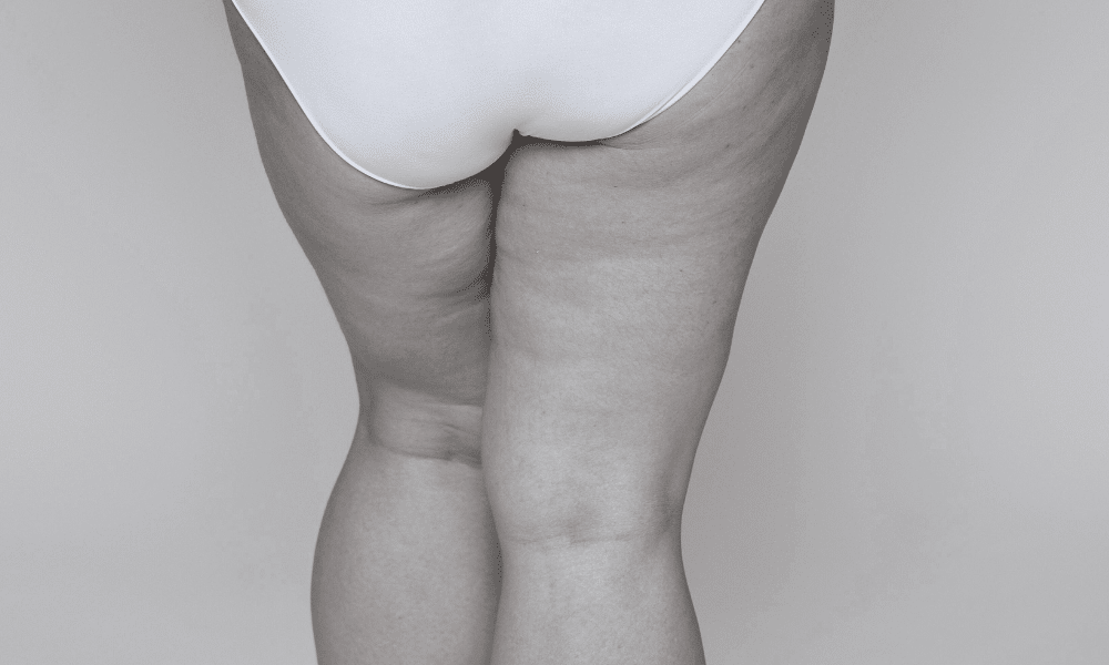 Lipedema: O Que É e Como Tratar Essa Condição?